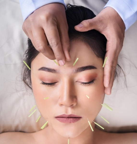 Acupuncture services provided by Bellpoint Health and Wellness